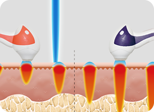 콜라겐 리모델링